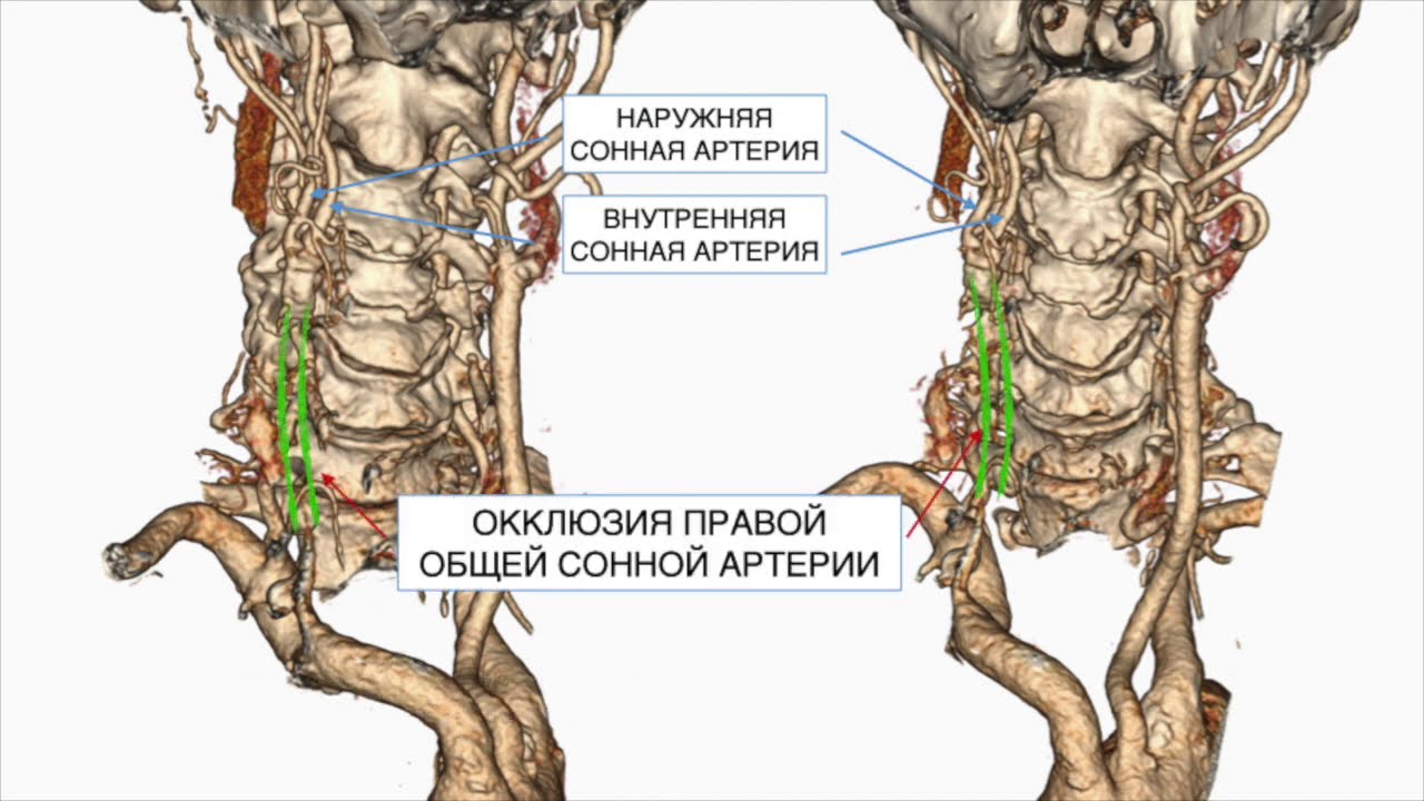 Эверсионная каротидная эндартерэктомия