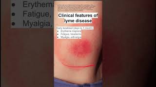 Clinical features of lyme disease