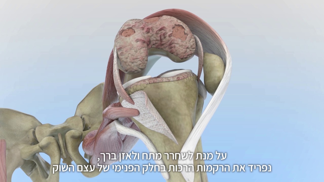סרטון הדגמה החלפת מפרק ברך