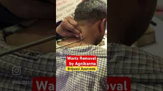 Wart removal by Agnikarm ayurveda agnikarma wartremoval wartstreatment ayurvedadoctor