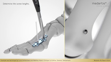 APTUS Foot Hallux System 2 8 Hallux Arthrodesis MTP 1 Fusion