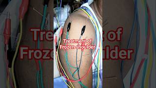 फ्रोजेन शोल्डर का ईलाज #shorts #frozenshoulder #acupuncture