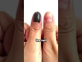 Her Nail Fell Off And Regenerated