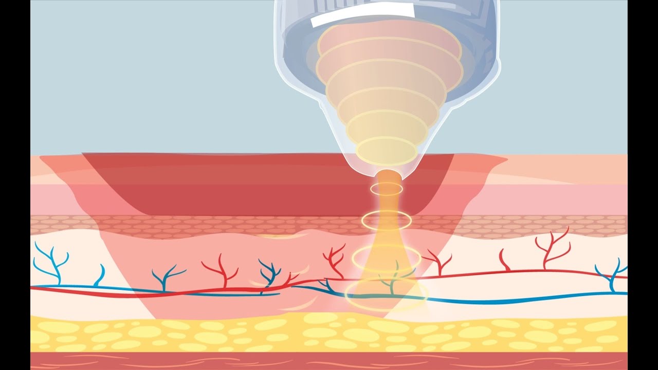 Extracorporeal Shock Wave Therapy: New Hope for Healing Acute and ...