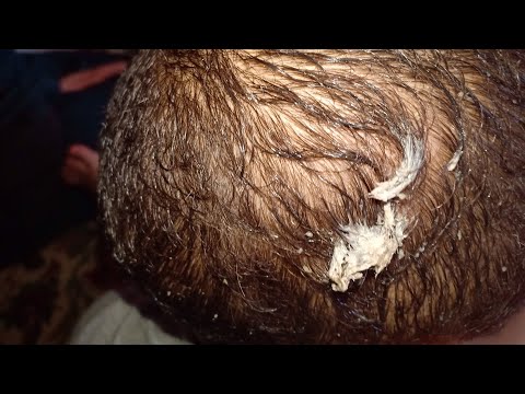 فيديو: كيفية إزالة العلكة من شعرك