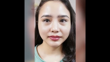 10 ngày sau khi độn cằm tại Dr.Hải Lê