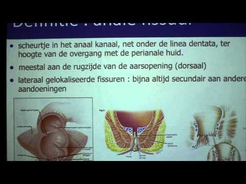 Video: Anale Fissuur - Behandeling, Operatie, Symptomen