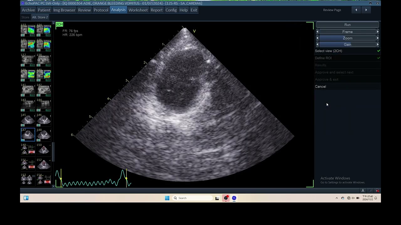 IQ 304 AUTOEF LV ECHOPAC ANALYSIS ECHOCARDIOGRAPHY MLNE