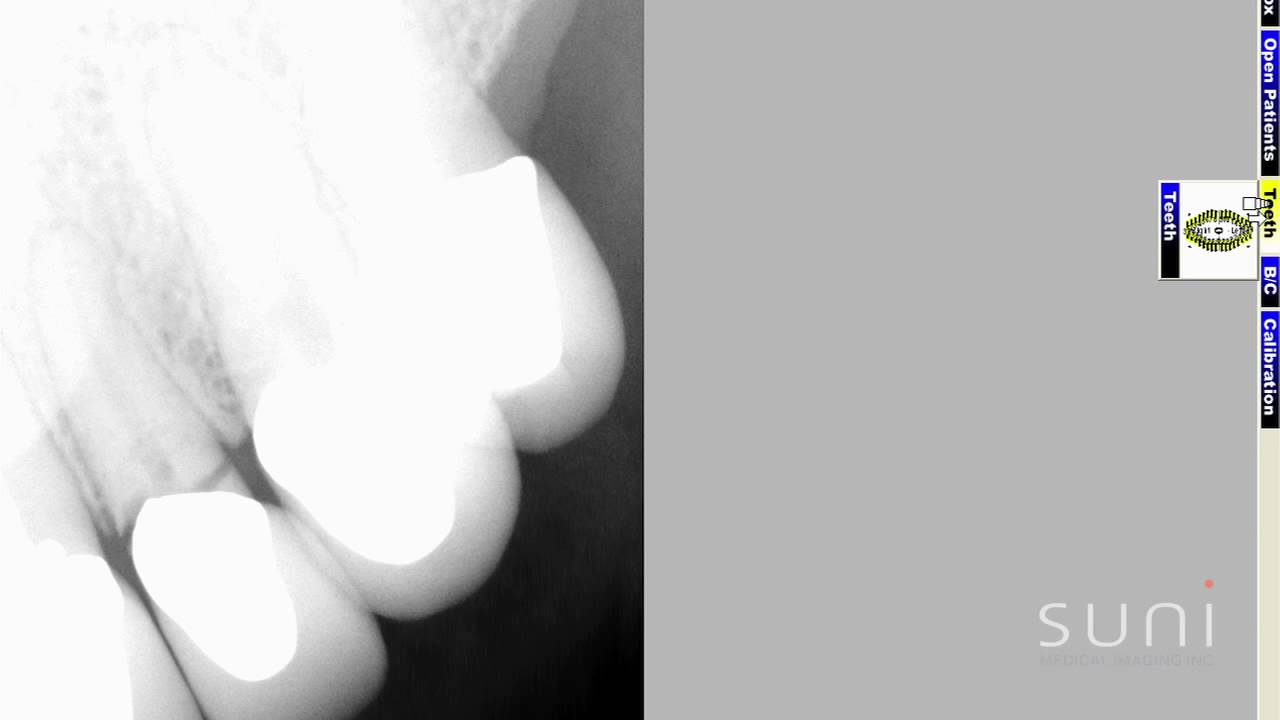 Intraoral Case Studies Imaged with Suni Sensors: Chapter 3