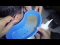 Disgusting Earwax Flushing with Pimple Popper Kit
