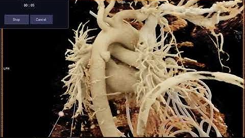 Aortic Dissection in Cinematic Rendering