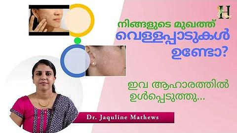 White patches on face | നിങ്ങളുടെ മുഖത്ത് വെള്ളപ്പാടുകൾ ഉണ്ടോ?| Dr Jaquline
