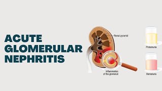 Acute Glomerular Nephritis