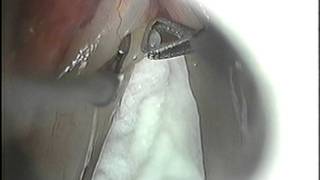 Vocal nodule  Microlaryngeal Surgery screenshot 5