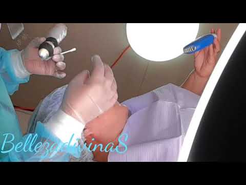 Retiro de lunares y verrugas con plasma pen 9671335583 - YouTube