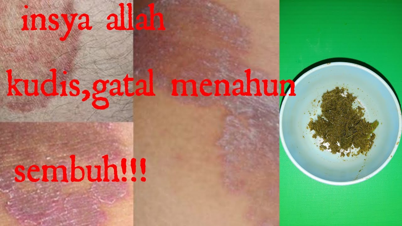 Cara mengobati penyakit kudis,gatal menahun|| INSYA ALLAH SEMBUH