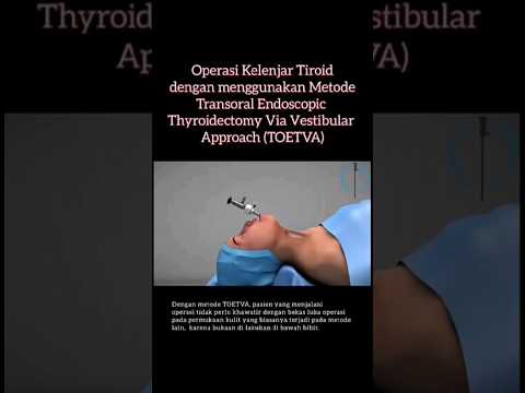 Inilah Proses Operasi Pengangkatan Tiroid Melalui Endoskopi (TOETVA) #tyroid #surgery #endoscopy