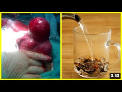 Vídeo: 3 maneiras de tratar a inflamação do útero