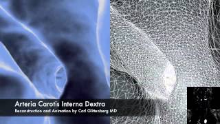 3D MRI Aneurysma Mesh