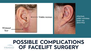 Famous Potential Facelift Complications, and How They are Avoided Wealth