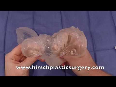 What are gummy bear breast implants, and how do they compare to