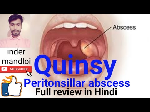 Quinsy(Peritonsillar abscess),Definition,causes,clinical features,diagnosis,complications,treatment