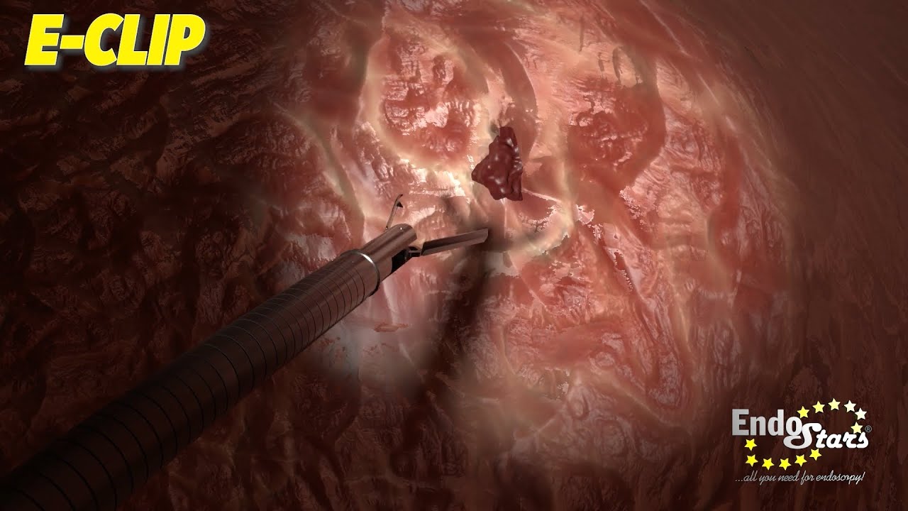 Endoscopic Clip Applicator ECLIP. Endo Stars LLC YouTube