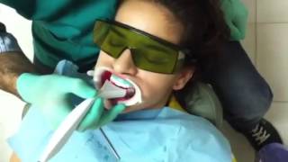 Thumbnail of Whitening Procedure using ZOLAR LASER