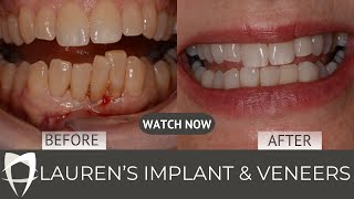 1.Patient Story: Dental Implant and Porcelain Veneers