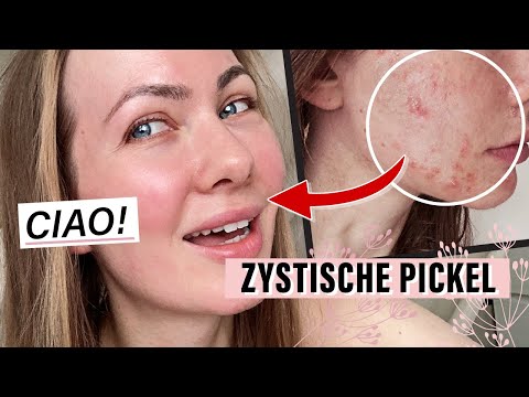 Video: Löst Ichthammol-Salbe Infektionen aus?