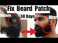 5 Ways To Fix Beard Patch Naturally In 30 Days Hindi