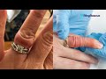 ANGRY FINGER Stuck Ring Removal Using The Ring Rescue Compression Device