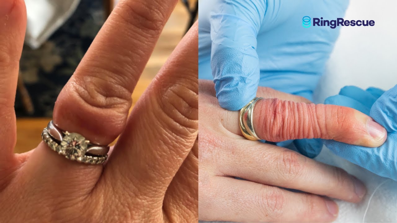 ANGRY FINGER Stuck Ring Removal Using The Ring Rescue Compression