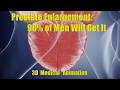 Benign Prostatic Hyperplasia (BPH) – Why You Wake Up to Pee at Night