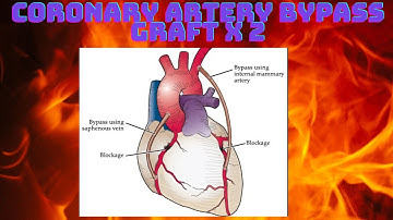 HOW TO CODE CORONARY ARTERY BYPASS GRAFT CABG X2