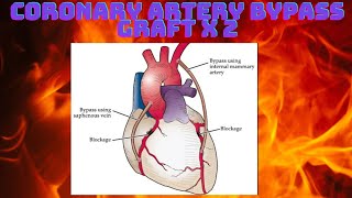 HOW TO CODE CORONARY ARTERY BYPASS GRAFT CABG X2 screenshot 3