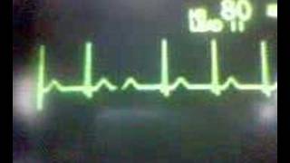 ECG Video: Junctional Rhythm