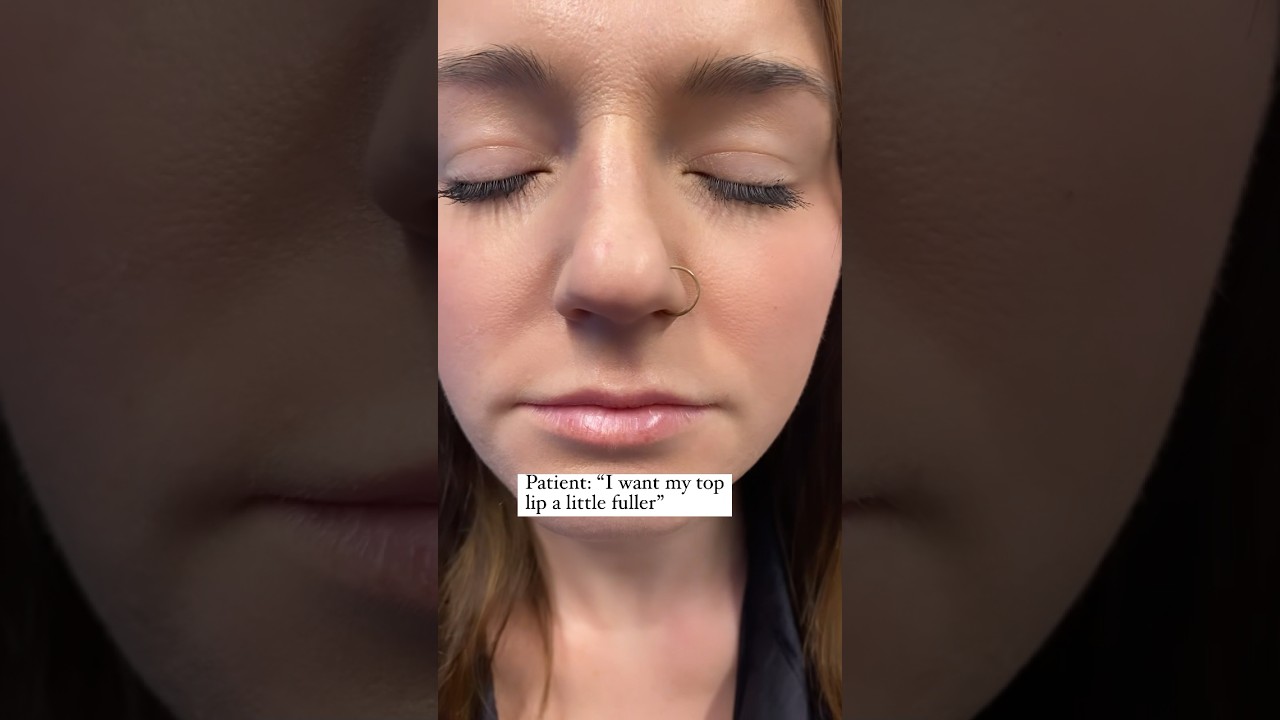 Lip Filler For Thin Lips