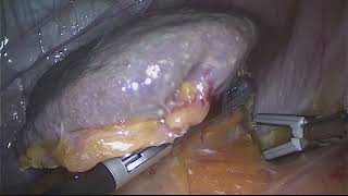 Splenectomy for ITP Using LigaSure Alone
