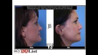 Neck Lift and Facelift Before and After from San Antonio Facial Plastic Surgeon Dr. Jose Barrera, MD