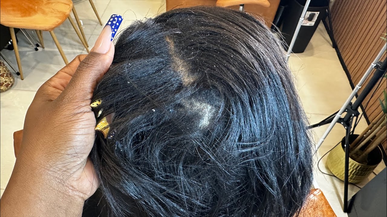 Dandruff or Damaged Scalp? How to Restore the Scalp in Real Time + Strengthening Weak Hair Follicles