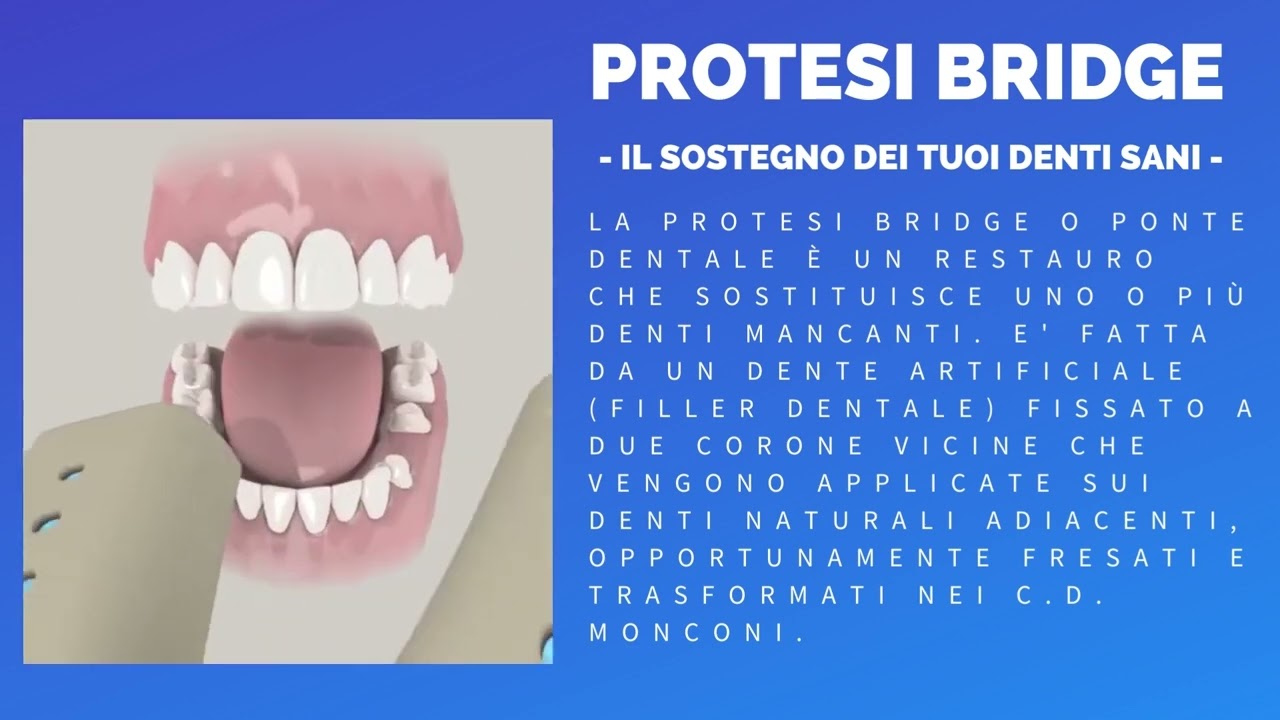 Dental Clinique Alessandria - PROTESI BRIDGE E LE PROTESI MOBILI IN NYLON
