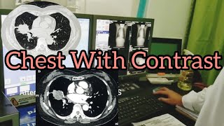 CT Scan of the Chest with Contrast | Hand Bolus | Radiology