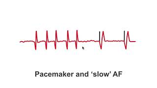 Pacemakers and "slow" AF patients