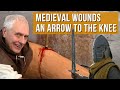 Medieval wounds  what happens when you take an arrow to the knee