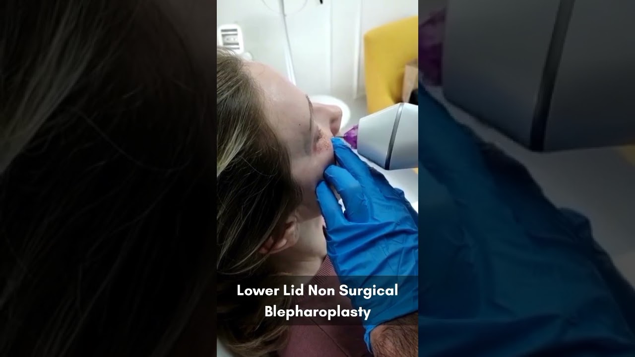 Fractional Plasma Rejuvenation Treatment | London Aesthetics Regenerative Center | 2022