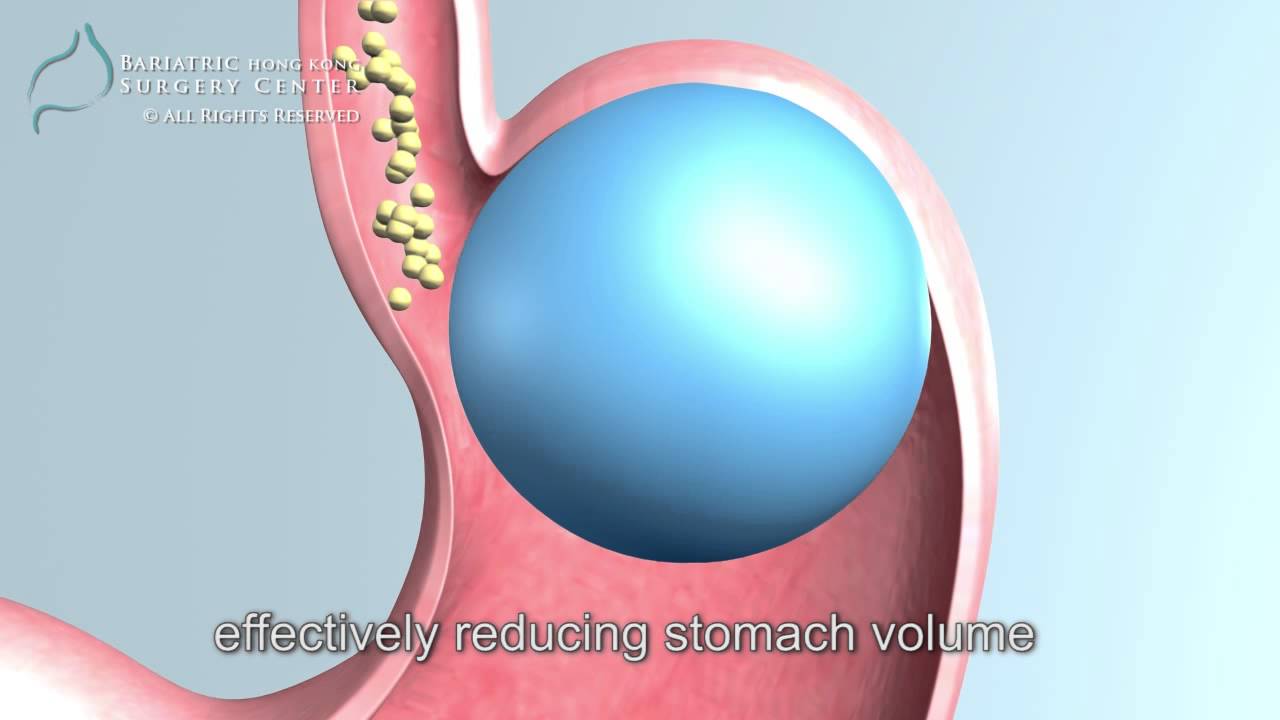 gastric balloon, gastric balloon weight loss, intragastric balloon