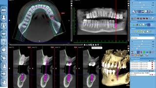 Basic Implant Planning in Romexis #1