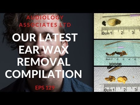 OUR LATEST EAR WAX REMOVAL COMPILATION - EP 129