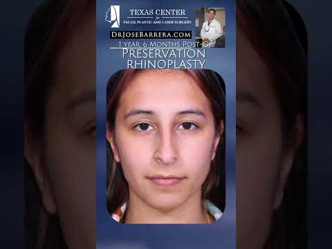 Video thumbnail: ✨ Same patient. Same beautiful face. Just a beautifully refined nose. 👃✨ · Dr. Jose Barrera